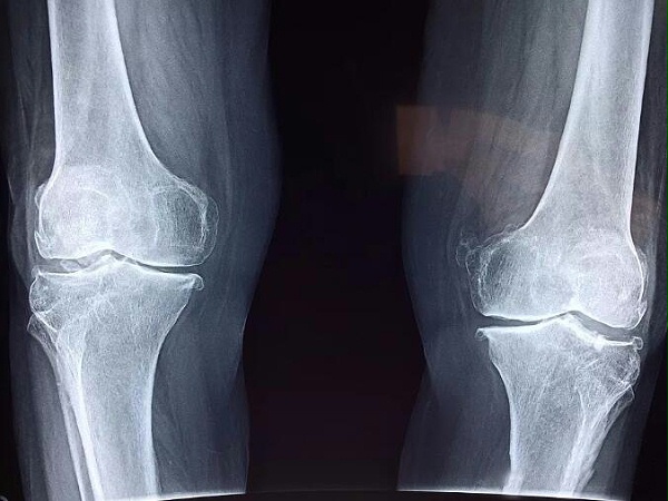膝关节CT片